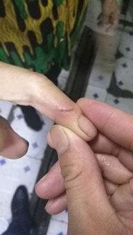 扩散 郑州女子被老鼠咬伤手指出血,干急找不到疫苗 