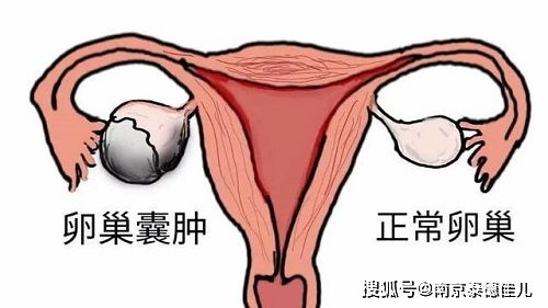 怀孕初期，发现卵巢囊肿怎么办(孕初期卵巢有囊肿)