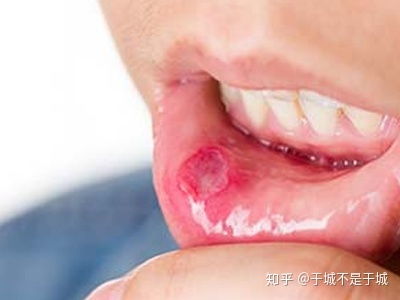 口腔溃疡是什么原因造成的