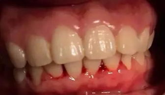牙龈出血是什么原因牙龈出血应该怎么治疗(牙龈出血是什么毛病引起的)