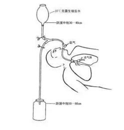 呼吸内科开展全院首例全麻下全肺大容量灌洗术