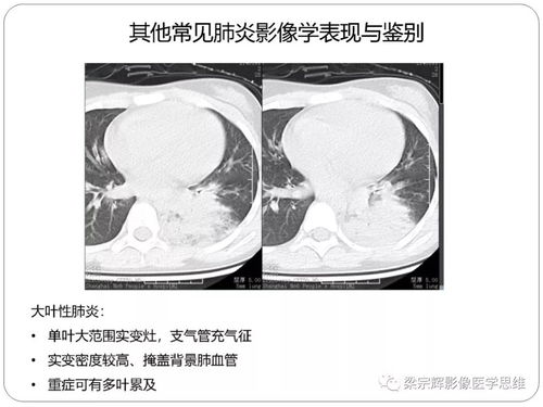 新冠状病毒肺炎影像学诊断与鉴别 心血管病医师需知