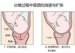 分娩中 开十指 是什么意思 附图