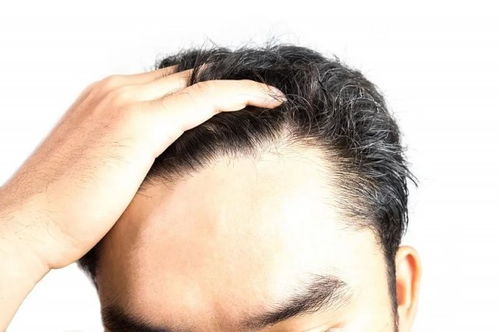 头秃有救了 自然 论文揭秘压力如何影响毛发生长
