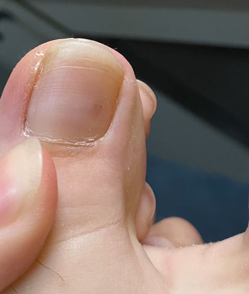 脚上指甲里面长了黑点点是不是黑色素瘤啊 
