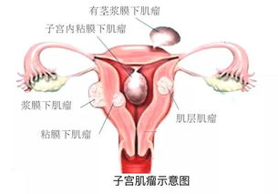 子宫肌瘤有什么症状有什么反应 子宫肌瘤有什么症状