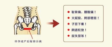 产后耻骨分离症用骨盆带哪种好 