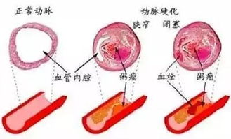 血管堵了,身体会出现哪些信号 