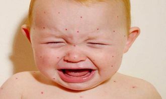 宝宝湿疹是怎么引起的？湿疹是怎么引起的原因