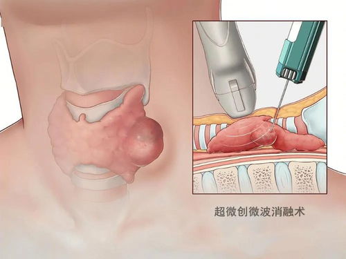 甲状腺微波消融术是什么(甲状腺微波消融术是什么技术)