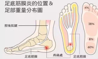 足底痛 你的脚是怎么了