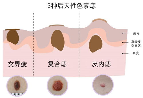 痣平的