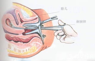 无痛人工流产术(无痛人工流产手术步骤)