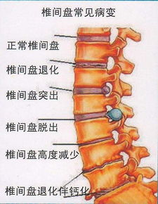 颈椎病,腰间盘突出久治不愈,这几个方法见效快