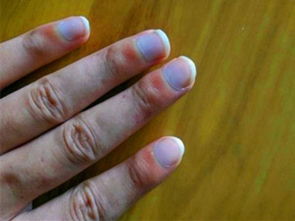 指甲横纹凹陷 指甲上有横纹是怎么回事？ 