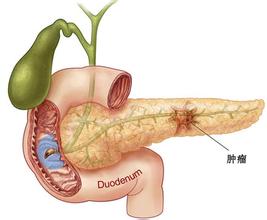 PET CT应用于胰腺癌早期筛查 