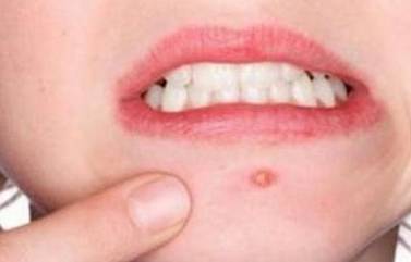 嘴巴周围反复长痘痘是什么原因(嘴巴周围反复长痘痘是什么原因导致)