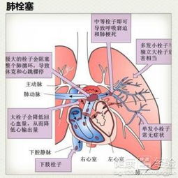 肺动脉栓塞的治疗