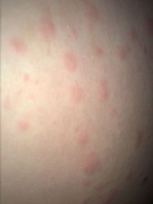 脸上胳膊上腿上屁股上脚上长了很多这样的痘痘,是不是过敏呀还是湿疹寻麻疹风疹之类的,吃氯雷他定片再涂 