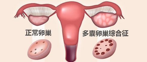 PCOS排卵少，能否选择试管助孕？