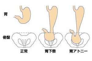 饭后运动会导致胃下垂 