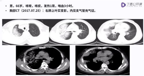 肺部细菌感染 CT 秒杀 一文总结各类影像特征