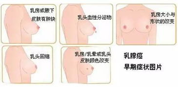 乳晕(乳晕是什么)