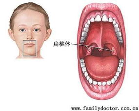 慢性扁桃腺能做手术吗 需要做手术摘除吗 