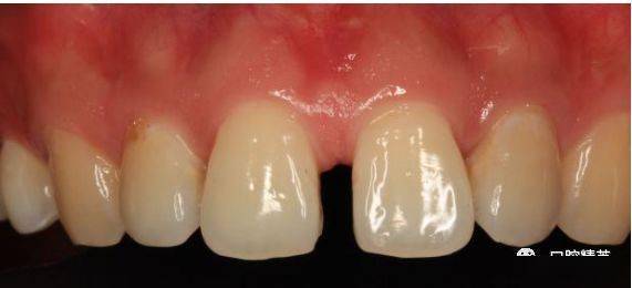 上左侧切牙比上右侧切牙出得晚吗(上左侧切牙比上右侧切牙出得晚吗图片)