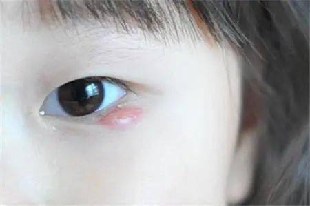 长麦粒肿,很难受又伤眼睛 学会预防是有必要的