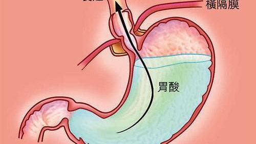 胃潰瘍活動期為什麼不適合喝牛奶?