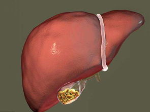 得了胆囊息肉会影响寿命吗 胆囊息肉切除能活几年 飞华健康网 