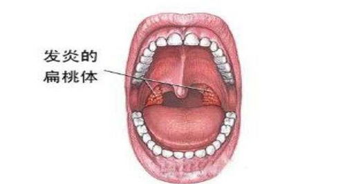 打通咽喉第一经方,咽炎 扁桃体炎 息肉,各种咽喉病一剂见效 