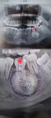 牙医要警惕 拔除松动牙,为什么一定要拍一个全景片