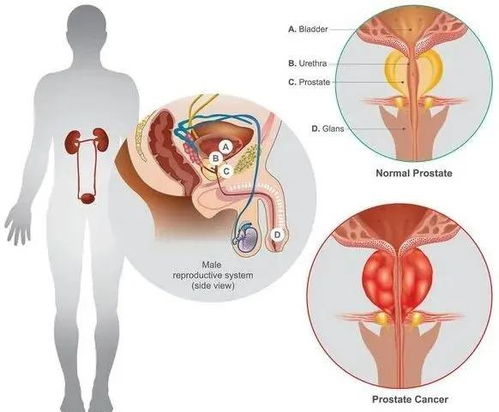 干细胞疗法干预前列腺炎,保护男性的 生命腺