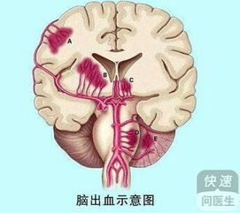 意外受伤会造成脑出血吗