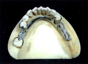 10084活动义齿 钢托活动义齿 隐形活动义齿 活动铸造支架 