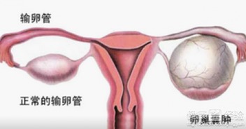 双侧卵巢囊肿严重吗？什么是双侧卵巢小囊肿严重吗