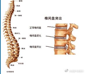 干货 腰椎间盘巨大突出造成马尾神经损伤,典型症状有哪些 都在这里