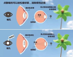 初次配镜为什么要散瞳验光