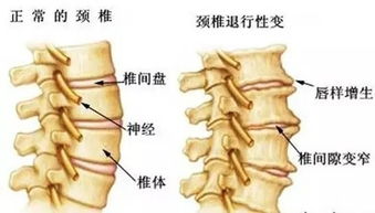 坐了颈椎手术后两个月了，会有头晕旋转的症状，怎么办(为什么做完颈椎手术两年后还头晕)