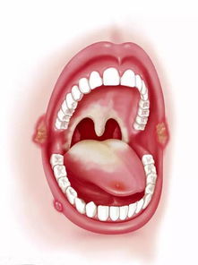 口腔溃疡是什么原因分析