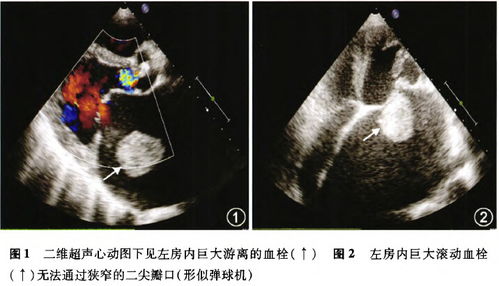 心房内巨大游离血栓一例 