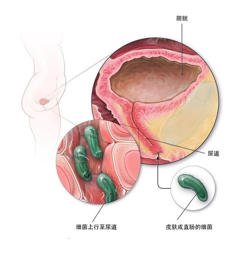 女性尿路感染症状，女性尿路感染症状有哪些典型表现