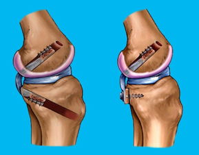 关节镜下后交叉韧带 PCL 重建手术康复 