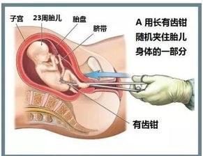 四张高清大图展示医生给胎儿流产全过程 比你想象的更残忍