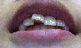 门牙太大外凸有点龅牙要不要箍牙