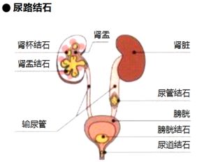 专家在线为你解析 尿道结石体外碎石多少钱 