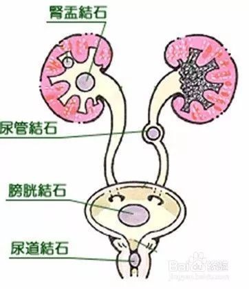 肾结石患者该怎么吃 记住这些饮食禁忌就行