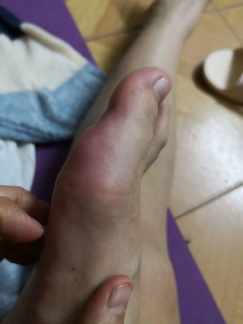 脚的大拇指与脚掌之间肿了是怎么回事 